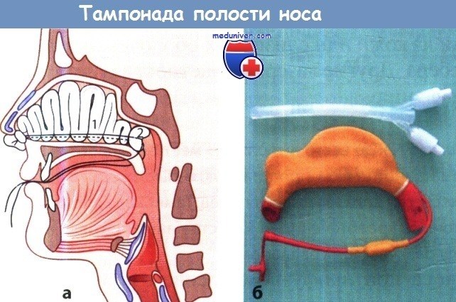 Передняя носовая коагуляция.