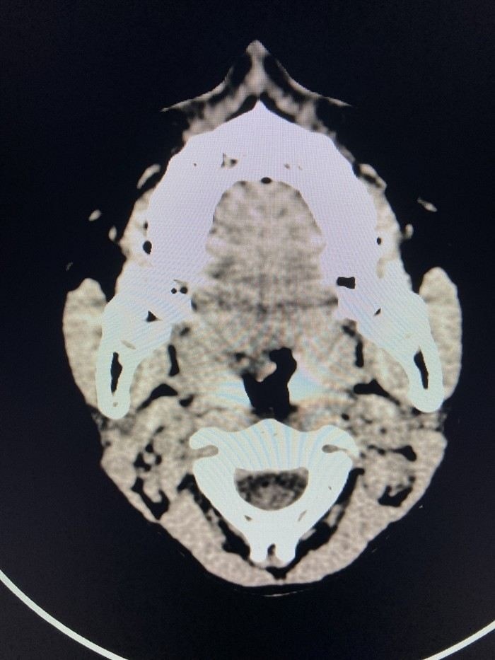 Как медицинская комиссия определяет годность к службе при аденоидах?