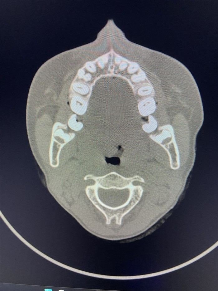 Какие симптомы аденоидов могут повлиять на годность к службе в армии?