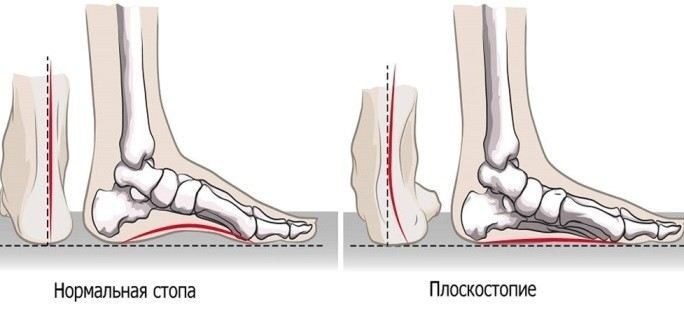 Какая степень плоскостопия влияет на призыв в армию?