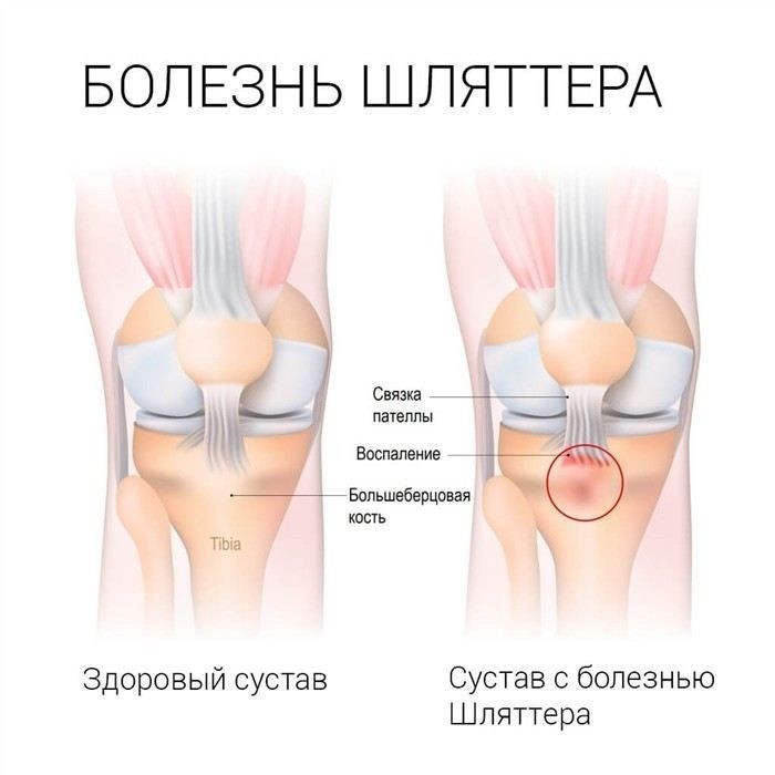 Можно ли получить отсрочку по болезни Шляттера
