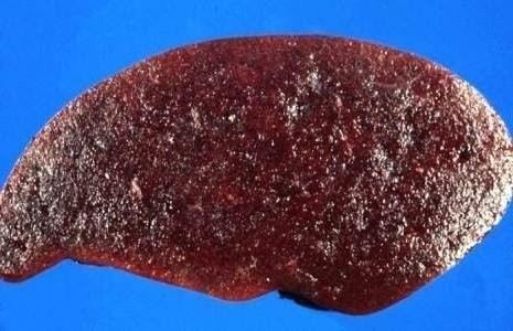 Что говорит о спленомегалии Расписание болезней