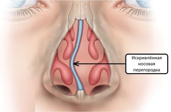 Как искривление носовой перегородки влияет на призывную годность?