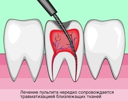 Опухла щека после лечения зуба: что это может значить?