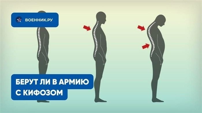 Какие степени кифоза могут стать причиной отсрочки