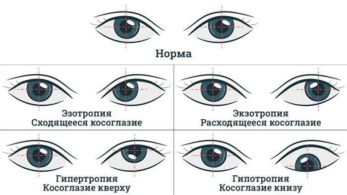 Как косоглазие влияет на медицинскую комиссию при призыве?