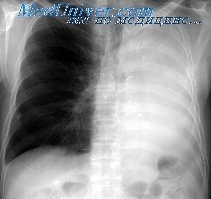 Противопоказания и ограничения при удалении легкого