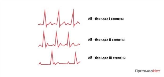 Как диагностируется блокада ножек пучка Гиса у призывников?