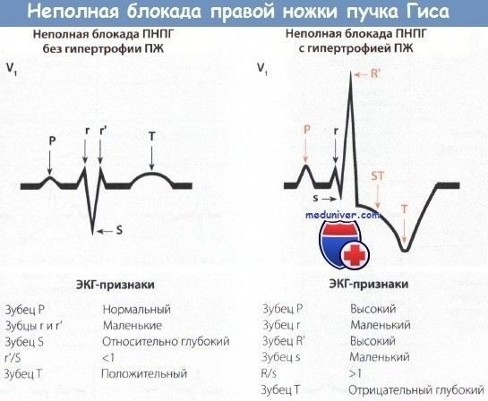 Причины развития неполной блокады правой ножки пучка Гиса