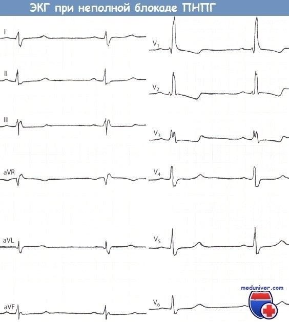 Признаки неполной блокады правой ножки пучка Гиса на ЭКГ