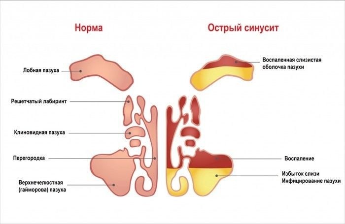 Как выбрать лечение для синусита в зависимости от стадии заболевания?