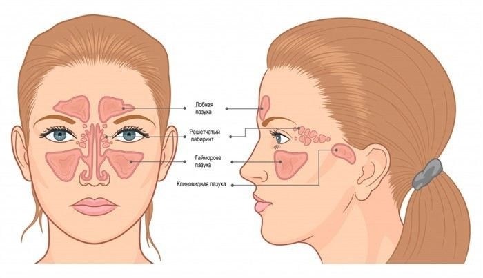Что такое синусит и как его распознать?