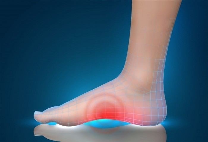Признаки плоскостопия, которые не стоит игнорировать