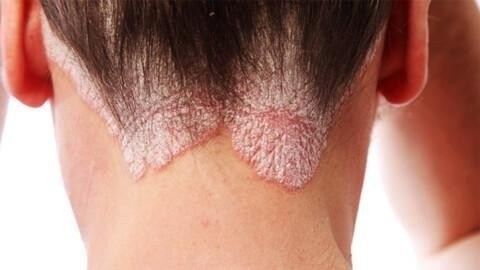 Нормативная основа: как регламентируется служба для призывников с псориазом?