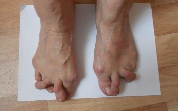 Как артрит влияет на категорию годности к военной службе