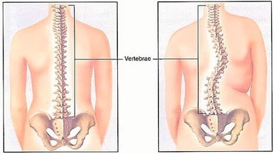 Сколиоз.
