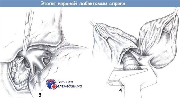 Реабилитация после лобэктомии легкого: что важно знать для успешного восстановления