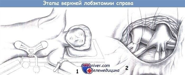 Удаление верхней доли правого легкого: последствия и восстановление