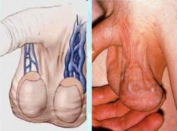 Как пройти медицинскую комиссию с диагнозом варикоцеле?