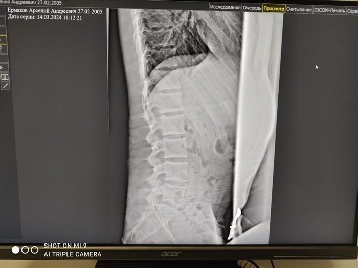 Какие медицинские категории существуют для призывников с болями в спине?