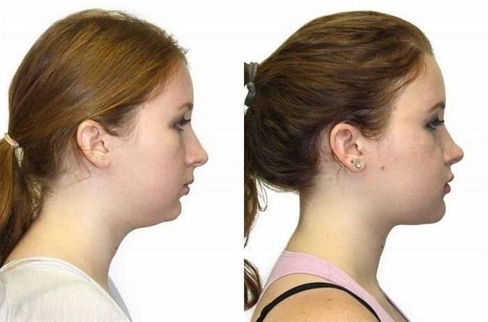 Какие бактерии в полости рта оказывают влияние на уровень сахара в крови