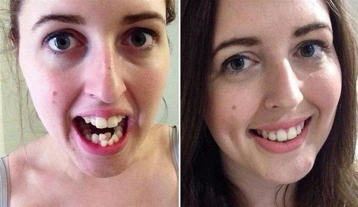 Как правильная гигиена полости рта помогает контролировать диабет